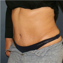 Tummy Tuck After Photo by Steve Laverson, MD, FACS; Rancho Santa Fe, CA - Case 41537