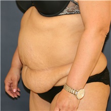 Tummy Tuck Before Photo by Steve Laverson, MD, FACS; Rancho Santa Fe, CA - Case 41537