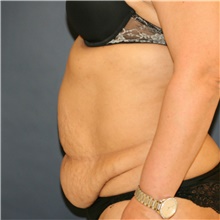 Tummy Tuck Before Photo by Steve Laverson, MD, FACS; Rancho Santa Fe, CA - Case 41537