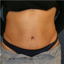 Tummy Tuck After Photo by Steve Laverson, MD, FACS; Rancho Santa Fe, CA - Case 41537