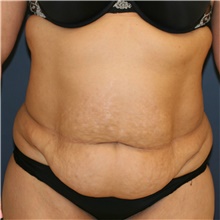 Tummy Tuck Before Photo by Steve Laverson, MD, FACS; Rancho Santa Fe, CA - Case 41537