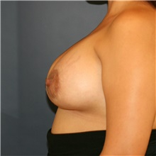 Breast Lift After Photo by Steve Laverson, MD, FACS; Rancho Santa Fe, CA - Case 41542