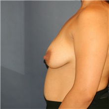 Breast Lift Before Photo by Steve Laverson, MD, FACS; San Diego, CA - Case 41542
