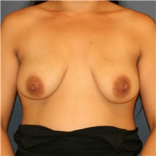 Breast Lift Before Photo by Steve Laverson, MD, FACS; San Diego, CA - Case 41542