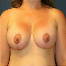 Breast Lift After Photo by Steve Laverson, MD; San Diego, CA - Case 41552