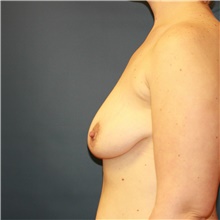 Breast Lift Before Photo by Steve Laverson, MD; San Diego, CA - Case 41552