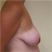 Breast Lift Before Photo by Steve Laverson, MD, FACS; Rancho Santa Fe, CA - Case 41553