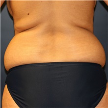 Liposuction Before Photo by Steve Laverson, MD, FACS; San Diego, CA - Case 41569