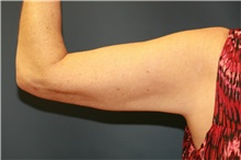 Liposuction After Photo by Steve Laverson, MD, FACS; Rancho Santa Fe, CA - Case 41582
