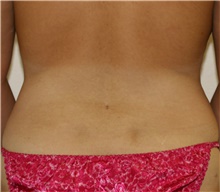 Liposuction After Photo by Steve Laverson, MD, FACS; San Diego, CA - Case 41586