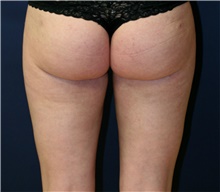 Liposuction After Photo by Steve Laverson, MD, FACS; San Diego, CA - Case 41587