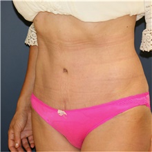 Tummy Tuck After Photo by Steve Laverson, MD, FACS; Rancho Santa Fe, CA - Case 41594