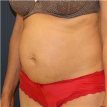 Tummy Tuck Before Photo by Steve Laverson, MD, FACS; Rancho Santa Fe, CA - Case 41594