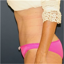 Tummy Tuck After Photo by Steve Laverson, MD, FACS; Rancho Santa Fe, CA - Case 41594