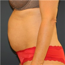 Tummy Tuck Before Photo by Steve Laverson, MD, FACS; Rancho Santa Fe, CA - Case 41594