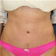 Tummy Tuck After Photo by Steve Laverson, MD, FACS; Rancho Santa Fe, CA - Case 41594