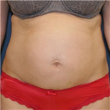 Tummy Tuck Before Photo by Steve Laverson, MD, FACS; Rancho Santa Fe, CA - Case 41594