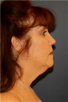 Facelift Before Photo by Steve Laverson, MD; San Diego, CA - Case 41608
