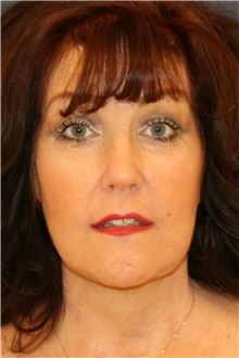 Facelift After Photo by Steve Laverson, MD, FACS; San Diego, CA - Case 41608
