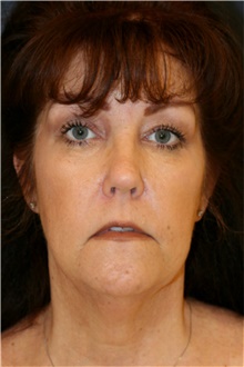 Facelift Before Photo by Steve Laverson, MD, FACS; San Diego, CA - Case 41608