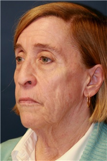 Facelift Before Photo by Steve Laverson, MD, FACS; Rancho Santa Fe, CA - Case 41632