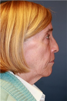 Facelift Before Photo by Steve Laverson, MD, FACS; Rancho Santa Fe, CA - Case 41632