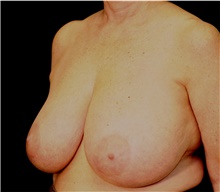 Breast Reduction Before Photo by Steve Laverson, MD, FACS; San Diego, CA - Case 41644