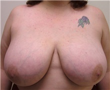 Breast Reduction Before Photo by Steve Laverson, MD, FACS; Rancho Santa Fe, CA - Case 41645