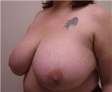 Breast Reduction Before Photo by Steve Laverson, MD, FACS; Rancho Santa Fe, CA - Case 41645