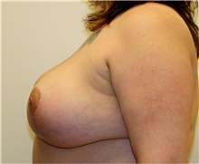 Breast Reduction After Photo by Steve Laverson, MD, FACS; Rancho Santa Fe, CA - Case 41645