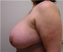 Breast Reduction Before Photo by Steve Laverson, MD, FACS; San Diego, CA - Case 41645
