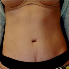 Tummy Tuck After Photo by Steve Laverson, MD, FACS; Rancho Santa Fe, CA - Case 41646