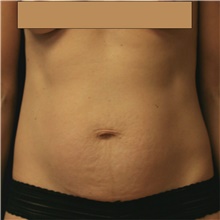 Tummy Tuck Before Photo by Steve Laverson, MD, FACS; Rancho Santa Fe, CA - Case 41646