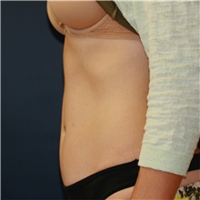 Tummy Tuck After Photo by Steve Laverson, MD, FACS; Rancho Santa Fe, CA - Case 41646