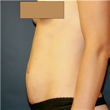 Tummy Tuck Before Photo by Steve Laverson, MD, FACS; Rancho Santa Fe, CA - Case 41646