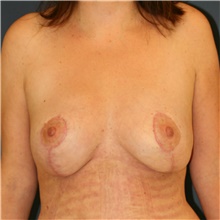 Breast Lift After Photo by Steve Laverson, MD, FACS; San Diego, CA - Case 41664