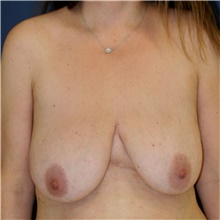 Breast Lift Before Photo by Steve Laverson, MD, FACS; San Diego, CA - Case 41664