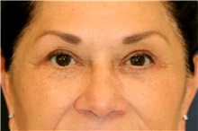 Eyelid Surgery After Photo by Steve Laverson, MD, FACS; San Diego, CA - Case 41691