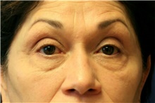 Eyelid Surgery Before Photo by Steve Laverson, MD, FACS; San Diego, CA - Case 41691