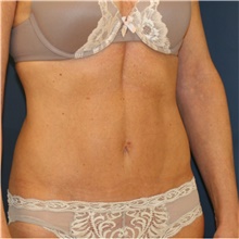 Tummy Tuck After Photo by Steve Laverson, MD, FACS; Rancho Santa Fe, CA - Case 41703