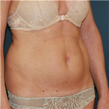 Tummy Tuck Before Photo by Steve Laverson, MD, FACS; Rancho Santa Fe, CA - Case 41703