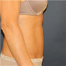 Tummy Tuck After Photo by Steve Laverson, MD, FACS; Rancho Santa Fe, CA - Case 41703