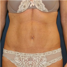 Tummy Tuck After Photo by Steve Laverson, MD, FACS; Rancho Santa Fe, CA - Case 41703