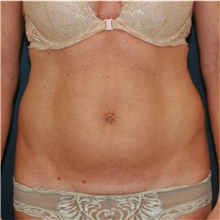 Tummy Tuck Before Photo by Steve Laverson, MD, FACS; Rancho Santa Fe, CA - Case 41703