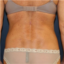 Liposuction After Photo by Steve Laverson, MD, FACS; San Diego, CA - Case 41708