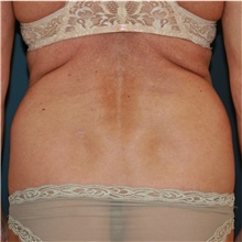 Liposuction Before Photo by Steve Laverson, MD, FACS; Rancho Santa Fe, CA - Case 41708