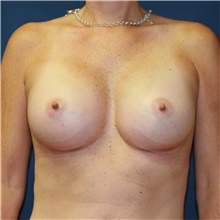 Breast Augmentation After Photo by Steve Laverson, MD, FACS; Rancho Santa Fe, CA - Case 41778