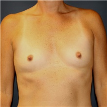 Breast Augmentation Before Photo by Steve Laverson, MD, FACS; Rancho Santa Fe, CA - Case 41778