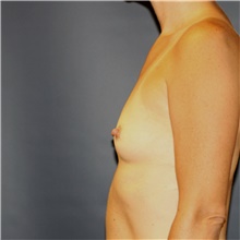 Breast Augmentation Before Photo by Steve Laverson, MD, FACS; Rancho Santa Fe, CA - Case 41778