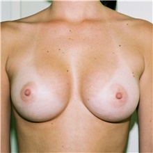 Breast Augmentation After Photo by Steve Laverson, MD, FACS; Rancho Santa Fe, CA - Case 41779